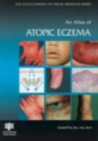 Atlas of Atopic Eczema